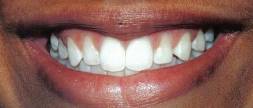 A close up of a person 's mouth with white teeth.