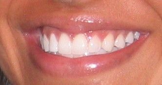 A close up of a woman 's smile with white teeth.