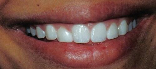 A close up of a person 's smile with white teeth.