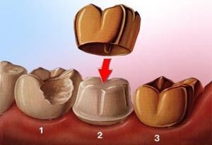 A dental crown is being placed on a tooth in Vernon Hill, IL