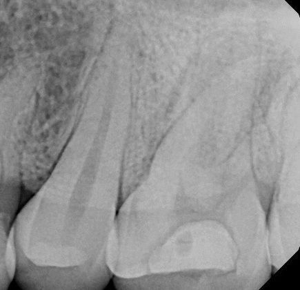 A black and white x-ray of a tooth with a hole in it.