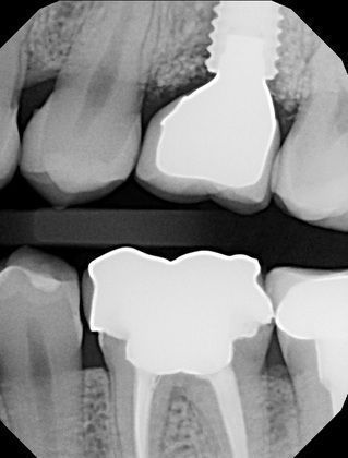 A black and white x-ray of a person 's teeth with a hole in one of the teeth.