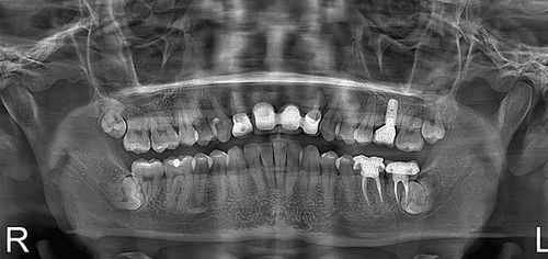 A black and white x-ray of a person 's teeth.