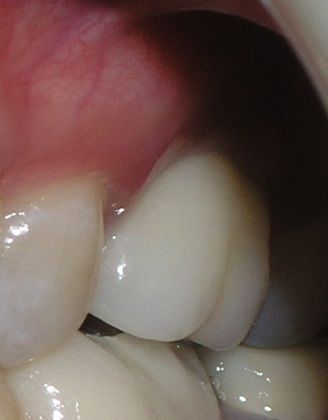 A close up of a person 's mouth with white teeth and red gums.