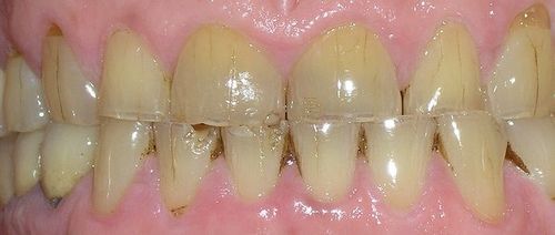 A close up of a person 's teeth with a lot of stains on them.