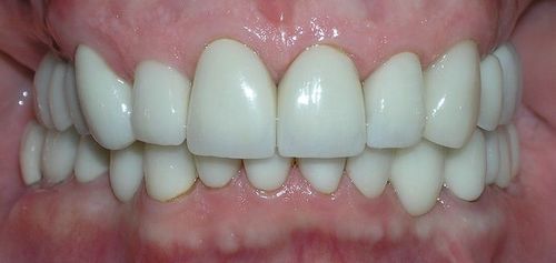 A close up of a person 's teeth with white porcelain crowns.