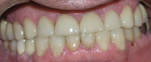 A close up of a person 's teeth with a dental mirror.