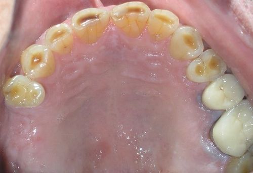 A close up of a person 's mouth with a lot of teeth.