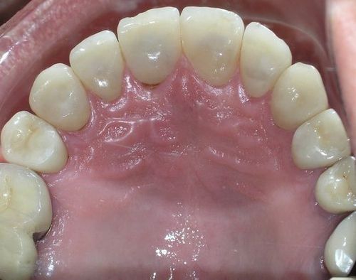 A close up of a person 's teeth in their mouth.
