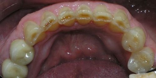 A close up of a person 's mouth with a lot of teeth.