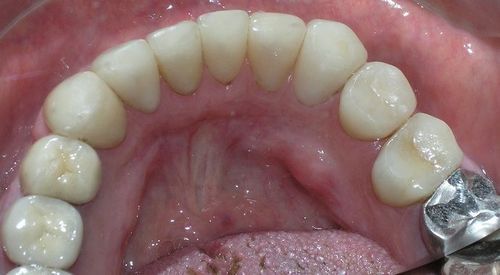 A close up of a person 's teeth with a metal crown.