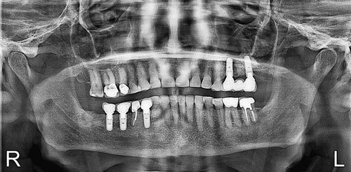 A black and white x-ray of a person 's teeth.