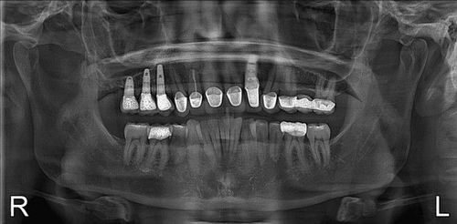 A black and white x-ray of a person 's teeth.