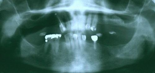 A close up of an x-ray of a person 's teeth.