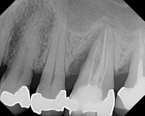 A black and white x-ray of a person 's teeth.