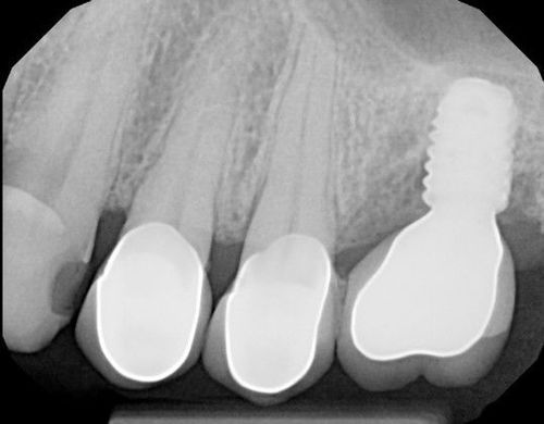 An x-ray of a person 's teeth showing a tooth with a hole in it.