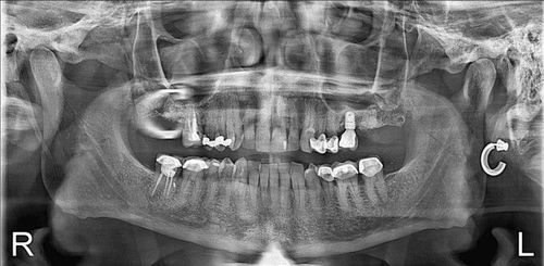 A black and white x-ray of a person 's teeth.