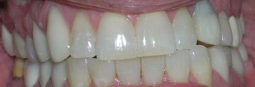 A close up of a person 's teeth with a broken tooth.