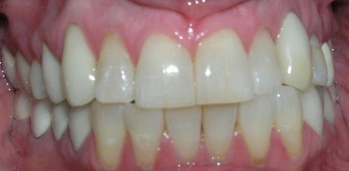 A close up of a person 's teeth with white teeth