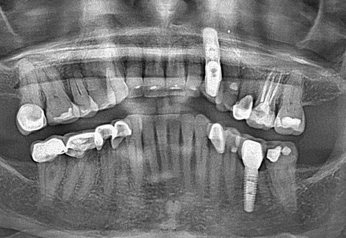 A black and white x-ray of a person 's teeth.