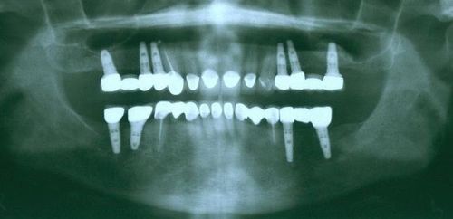 An x-ray of a person 's teeth with dental implants.