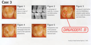 A picture of a tooth with the words case 3 on it