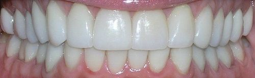 A close up of a person 's teeth with white teeth.