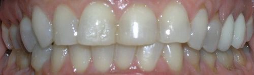 A close up of a person 's teeth with white teeth.