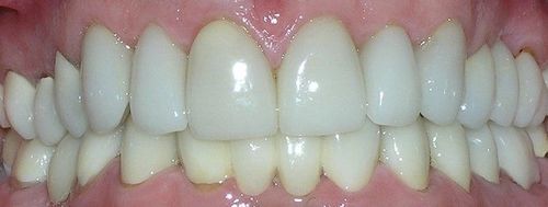 A close up of a person 's teeth with white teeth.