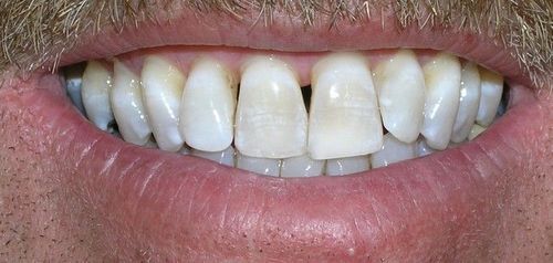 A close up of a man 's teeth with a beard.