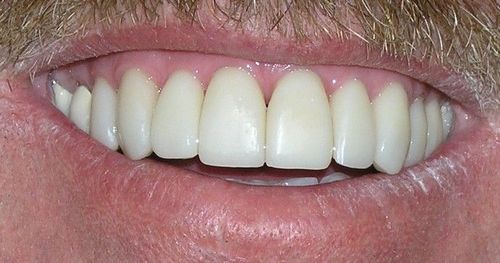 A close up of a man 's teeth with a beard.