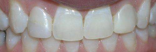 A close up of a person 's teeth with white teeth.