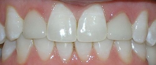 A close up of a person 's teeth with white teeth.