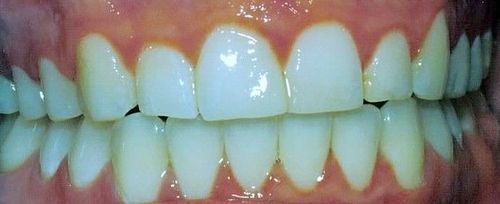 A close up of a person 's teeth with white teeth.