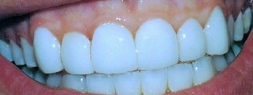 A close up of a person 's teeth with white teeth.