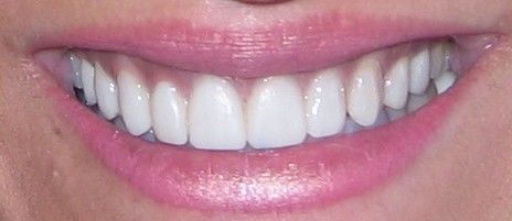 A close up of a woman 's smile with white teeth and pink lips.