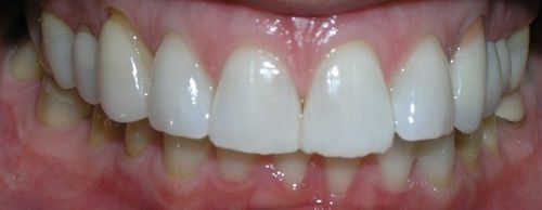 A close up of a person 's teeth with white teeth.