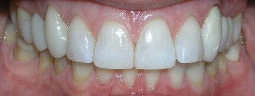 A close up of a person 's teeth with white teeth.