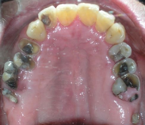 A close up of a person 's mouth with a lot of teeth.