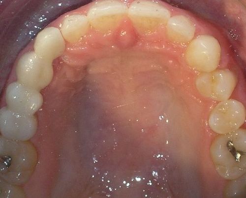 A close up of a person 's mouth with teeth and gums.