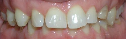 A close up of a person 's teeth with white teeth.