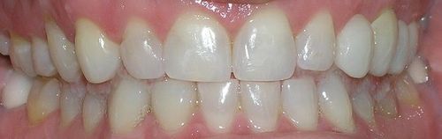 A close up of a person 's teeth with white teeth.