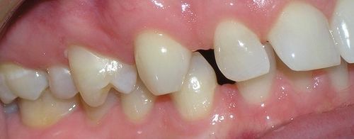 A close up of a person 's teeth with a hole in the middle.