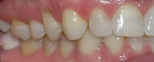 A close up of a person 's teeth and gums.