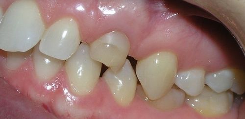 A close up of a person 's teeth with a missing tooth.