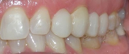 A close up of a person 's teeth with white teeth.