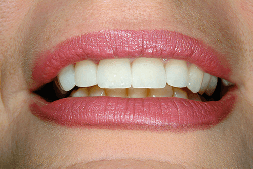 smile after makeover