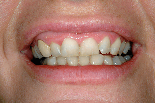 smile before makeover