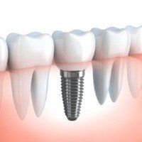 Implant Dentistry