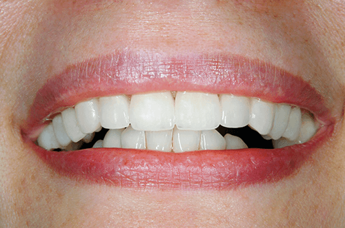 smile after whitening, crowns and veneers